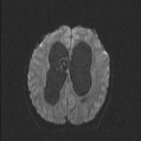 Central neurocytoma (Radiopaedia 56690-63469 Axial DWI 52).jpg