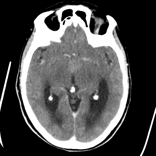 Central neurocytoma (Radiopaedia 65317-74346 Axial C+ delayed 22).png