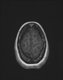 File:Central neurocytoma (Radiopaedia 84497-99872 Axial T1 168).jpg