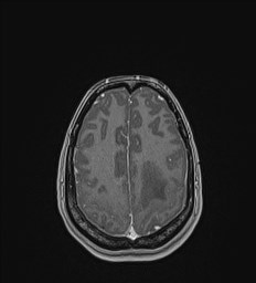 File:Central neurocytoma (Radiopaedia 84497-99872 Axial T1 C+ 123).jpg