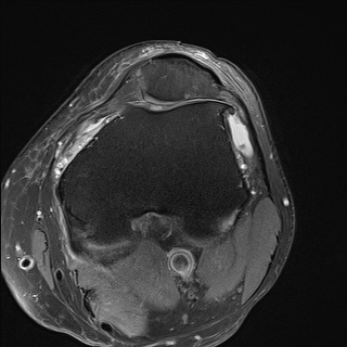 File:Central osteophyte (Radiopaedia 72592-83151 Axial PD fat sat 10).jpg