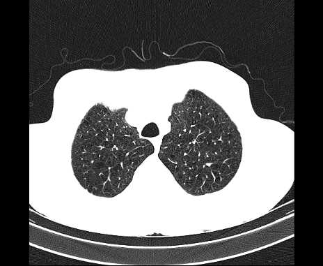 Centrilobular pulmonary emphysema (Radiopaedia 62468-70718 Axial lung window 13).jpg