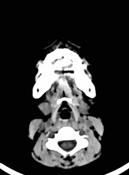 Cerebellar abscess (Radiopaedia 73727-84527 Axial non-contrast 3).jpg