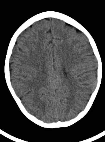 Cerebellar abscess (Radiopaedia 73727-84527 Axial non-contrast 46).jpg