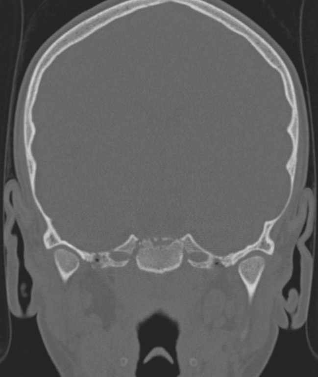Cerebellar abscess (Radiopaedia 73727-84527 Coronal bone window 90).jpg