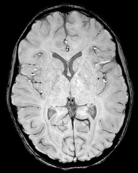 Cerebellar abscess (Radiopaedia 73727-84563 Axial SWI 38).jpg