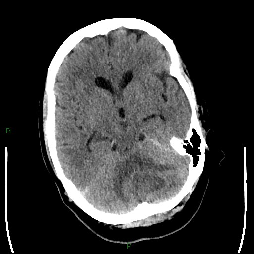 Cerebellar abscess (Radiopaedia 78135-90671 Axial non-contrast 42).jpg
