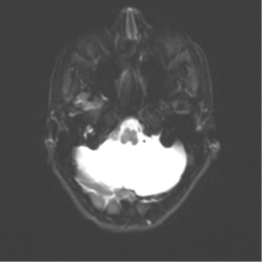 Cerebellar agenesis with hypoplastic pons (pontocerebellar hypoplasia) (Radiopaedia 57224-64138 Axial DWI 10).png