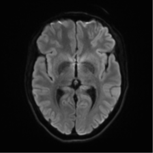 Cerebellar agenesis with hypoplastic pons (pontocerebellar hypoplasia) (Radiopaedia 57224-64138 Axial DWI 55).png