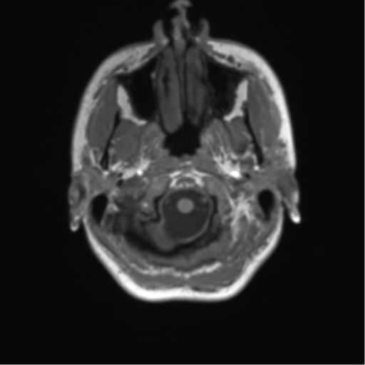 Cerebellar agenesis with hypoplastic pons (pontocerebellar hypoplasia) (Radiopaedia 57224-64138 Axial T1 9).png