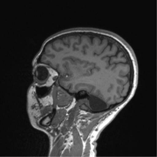 Cerebellar agenesis with hypoplastic pons (pontocerebellar hypoplasia) (Radiopaedia 57224-64138 Sagittal T1 48).png