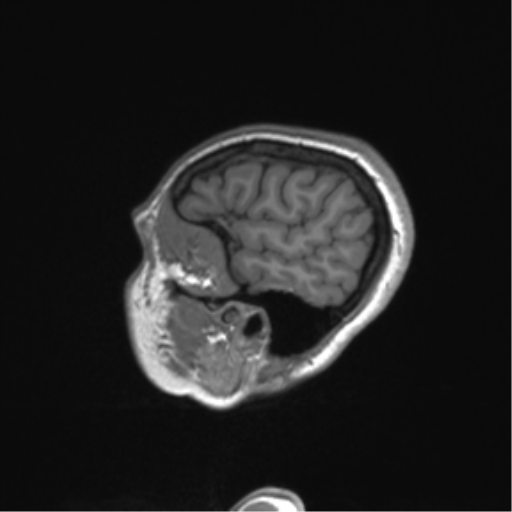 Cerebellar agenesis with hypoplastic pons (pontocerebellar hypoplasia) (Radiopaedia 57224-64138 Sagittal T1 56).png