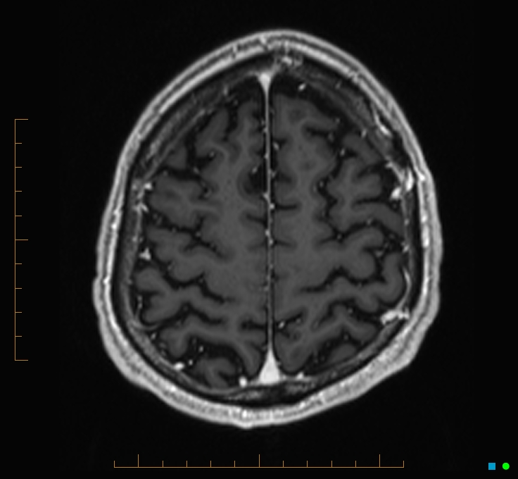 Cerebellar gangliocytoma (Radiopaedia 65377-74422 Axial T1 C+ 117).jpg