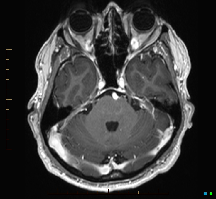 Cerebellar gangliocytoma (Radiopaedia 65377-74422 Axial T1 C+ 32).jpg
