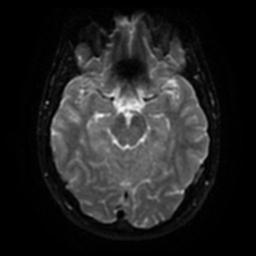 Cerebellar hemangioblastoma (Radiopaedia 29570-30077 Axial DWI 37).jpg