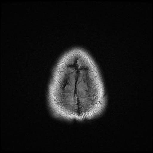 File:Cerebellar hemangioblastoma (Radiopaedia 88055-104622 Axial FLAIR 24).jpg