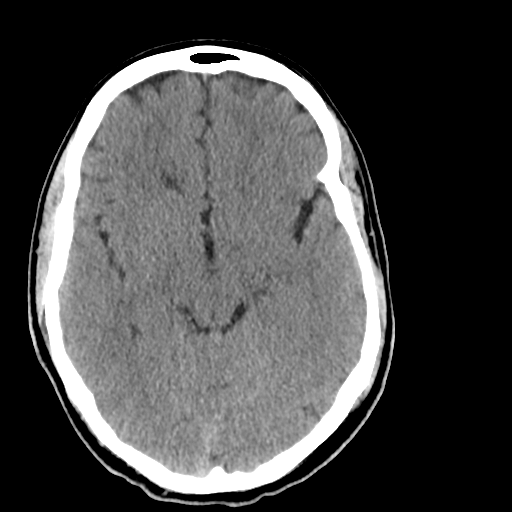 File:Cerebellar infarct due to vertebral artery dissection with posterior fossa decompression (Radiopaedia 82779-97029 Axial non-contrast 11).png