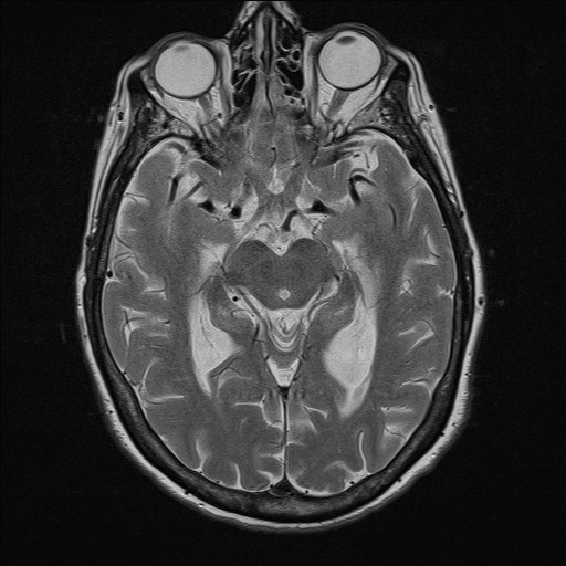 File:Cerebellar metastases (Radiopaedia 24038-24249 Axial T2 2).jpg