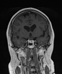 File:Cerebellar metastasis (Radiopaedia 54578-60810 Coronal T1 C+ 15).png