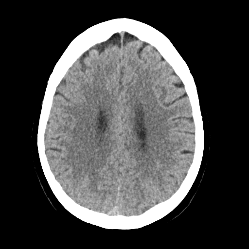 Cerebellar metastasis (Radiopaedia 54578-60812 Axial non-contrast 34).png