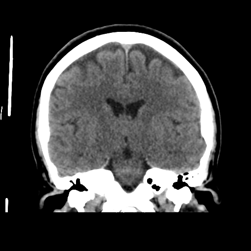 Cerebellar metastasis (cystic appearance) (Radiopaedia 41395-44258 Coronal non-contrast 33).png
