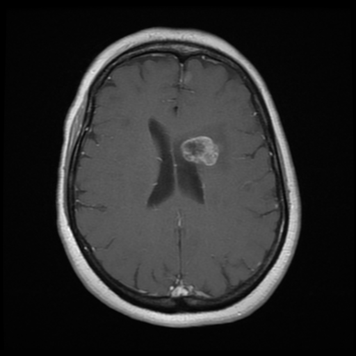File:Cerebellar metastasis (cystic appearance) (Radiopaedia 41395-44268 Axial T1 C+ 15).png