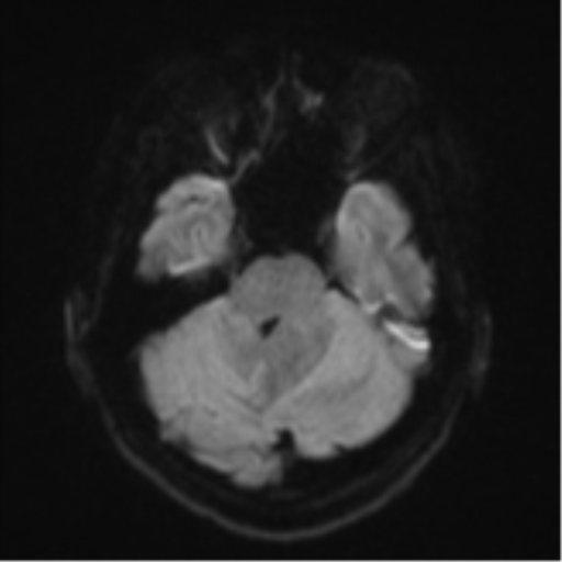 Cerebellar metastasis - adenocarcinoma lung (Radiopaedia 63184-71715 Axial DWI 37).png