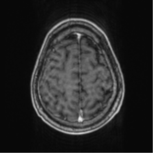 Cerebellar metastasis from lung adenocarcinoma (Radiopaedia 86690-102829 Axial T1 C+ 66).png