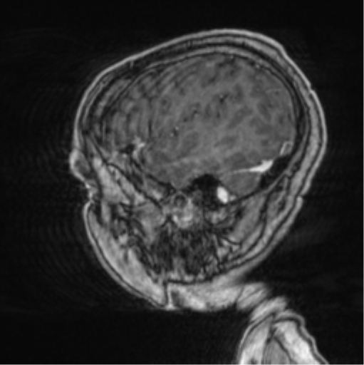 Cerebellar metastasis from lung adenocarcinoma (Radiopaedia 86690-102829 Sagittal T1 C+ 16).png