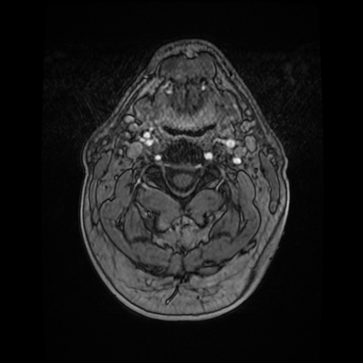 Cerebellar metastasis of pulmonary adenocarcinoma, cavernous venous malformation, and developmental venous anomaly (Radiopaedia 85827-101661 Axial T1 C+ 3).jpg