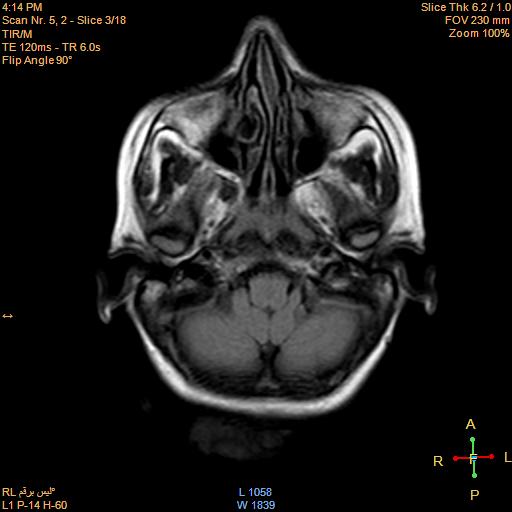 File:Cerebellopontine angle meningioma (Radiopaedia 22488-22525 Axial FLAIR 1).jpg