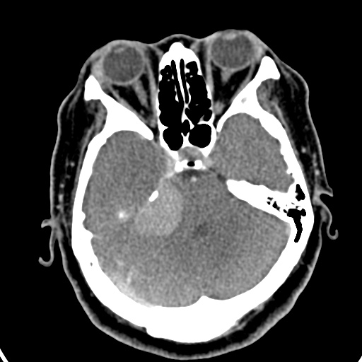 Cerebellopontine angle meningioma (Radiopaedia 35181-36714 A 19).jpg