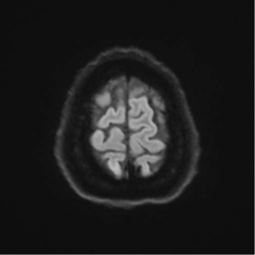 Cerebellopontine angle meningioma (Radiopaedia 48434-53348 Axial DWI 72).png