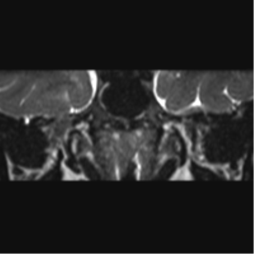 File:Cerebellopontine angle meningioma (Radiopaedia 48434-53348 Coronal T2 77).png