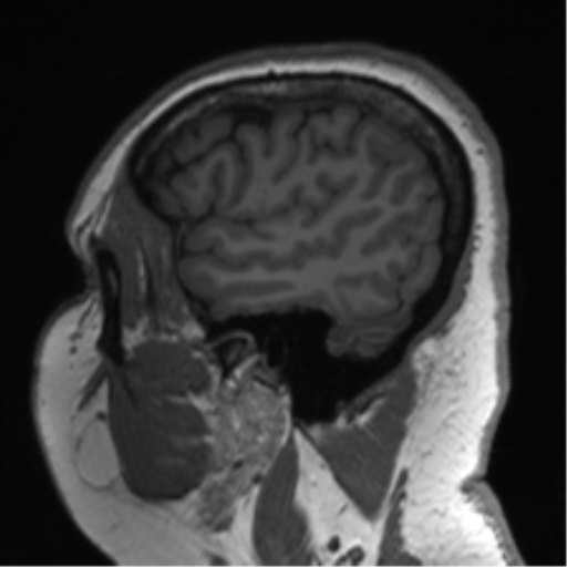 File:Cerebellopontine angle meningioma (Radiopaedia 48434-53348 Sagittal T1 74).png