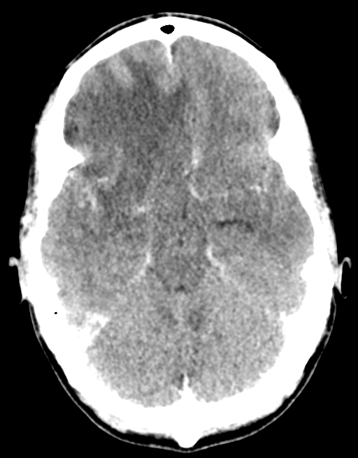 Cerebral abscess (Radiopaedia 60342-68008 Axial C+ delayed 19).png