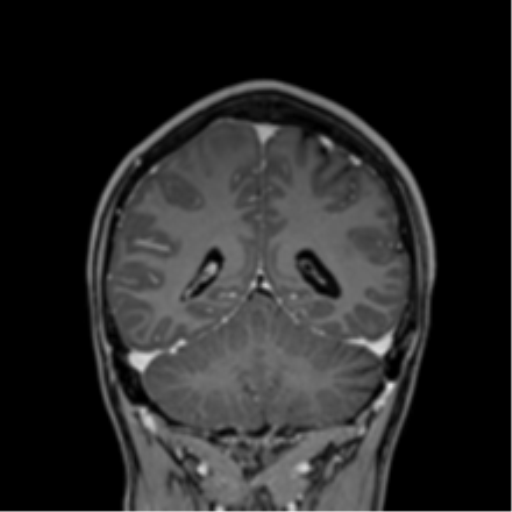 File:Cerebral abscess (Radiopaedia 60342-68009 H 12).png