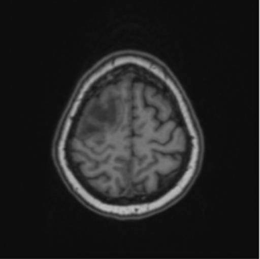 Cerebral abscess from pulmonary arteriovenous malformation (Radiopaedia 86275-102291 Axial T1 63).png