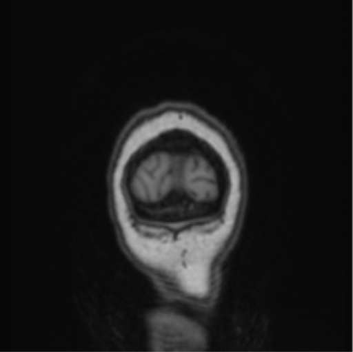 Cerebral abscess from pulmonary arteriovenous malformation (Radiopaedia 86275-102291 Coronal T1 7).png