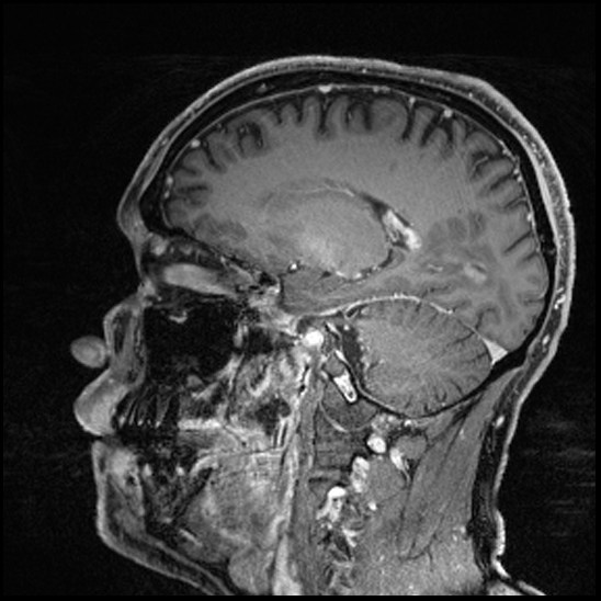 Cerebral abscess with ventriculitis (Radiopaedia 78965-91878 Sagittal T1 C+ 71).jpg