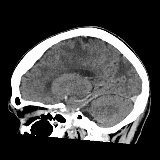 Cerebral amyloid angiopathy-related inflammation (Radiopaedia 74836-85848 C 37).jpg