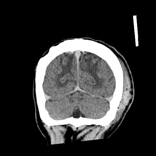 Cerebral amyloid angiopathy-related inflammation (Radiopaedia 74836-85848 Coronal non-contrast 61).jpg