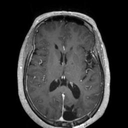 Cerebral amyloid angiopathy (Radiopaedia 29129-29518 Axial T1 C+ 82).jpg