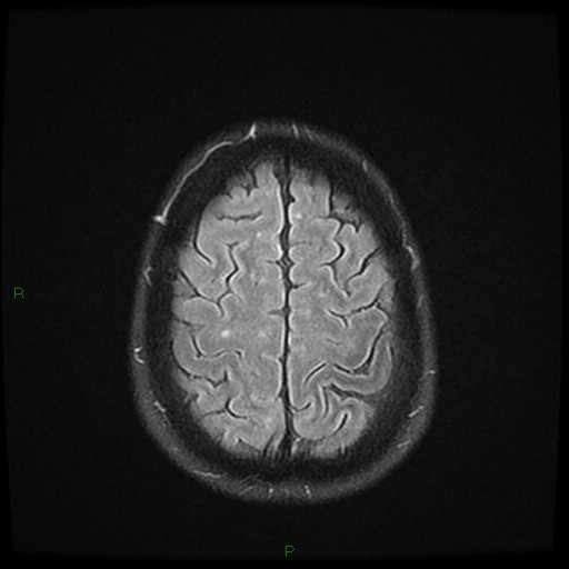 File:Cerebral amyloid angiopathy (Radiopaedia 77506-89664 Axial FLAIR 24).jpg