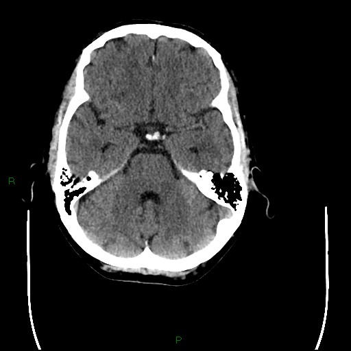 Cerebral amyloid angiopathy (Radiopaedia 77506-89665 Axial non-contrast 33).jpg