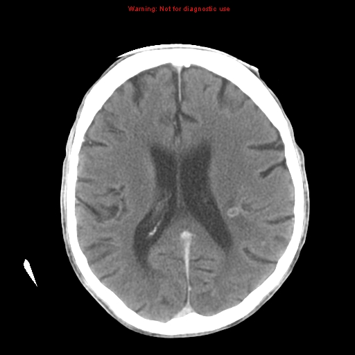 File:Cerebral and orbital tuberculomas (Radiopaedia 13308-13310 B 18).jpg