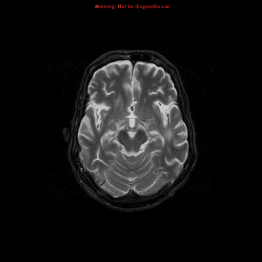 File:Cerebral and orbital tuberculomas (Radiopaedia 13308-13311 Axial T2 9).jpg