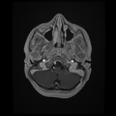 File:Cerebral and spinal tuberculosis (Radiopaedia 90489-107837 Axial T1 C+ 43).jpg