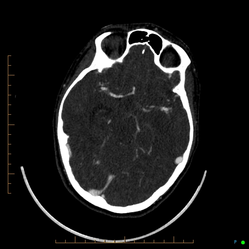 Cerebral arteriovenous malformation (AVM) (Radiopaedia 78162-90706 Axial CTA 118).jpg