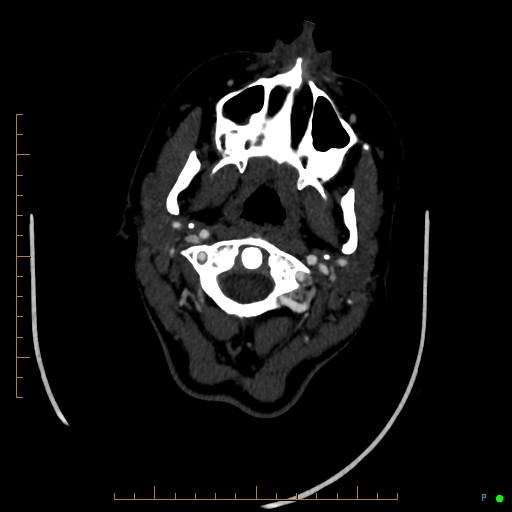 Cerebral arteriovenous malformation (AVM) (Radiopaedia 78162-90706 Axial CTA 30).jpg